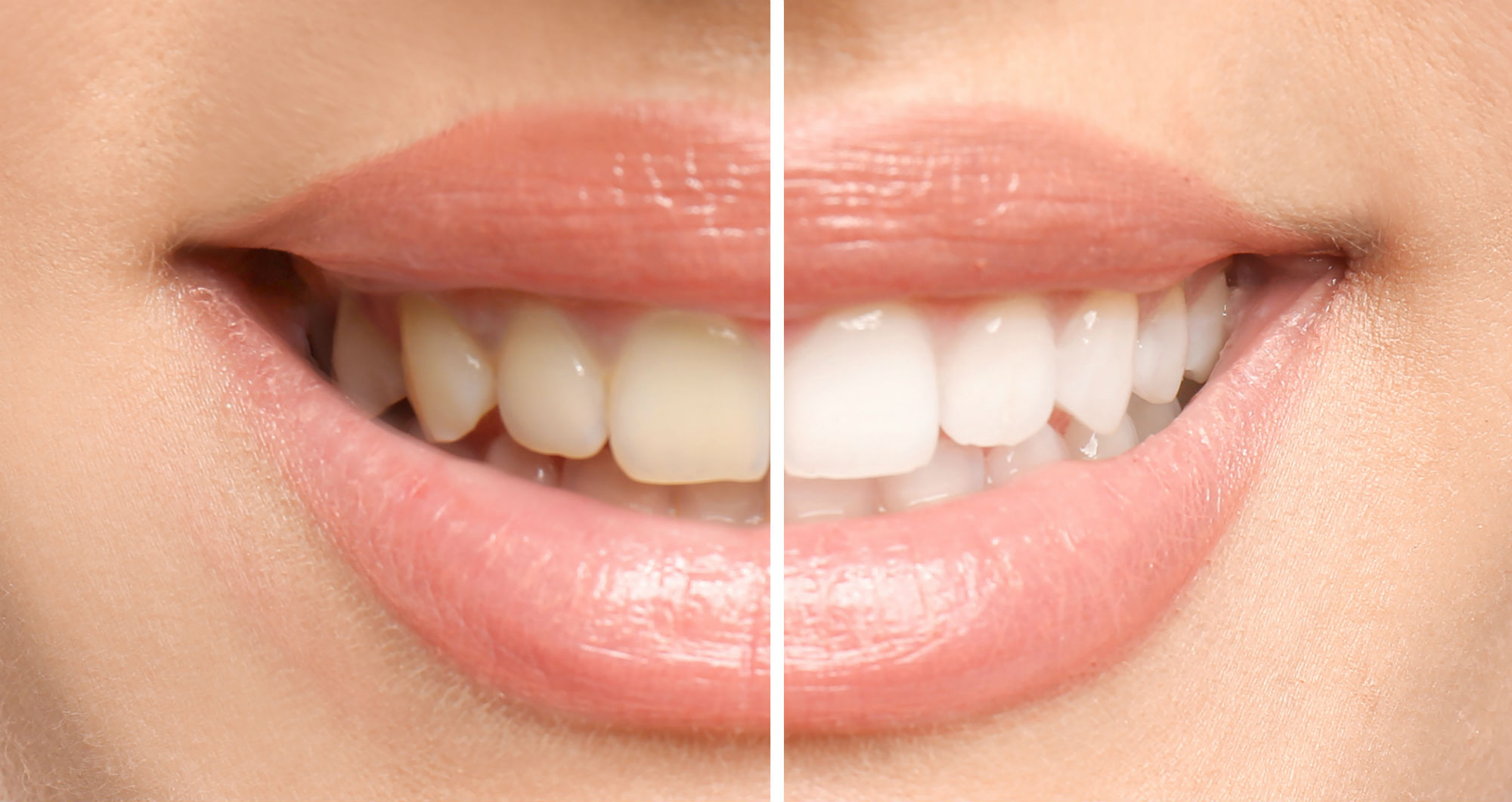 ZOOM Teeth Whitening Advanced Dentistry of Mount Pleasant